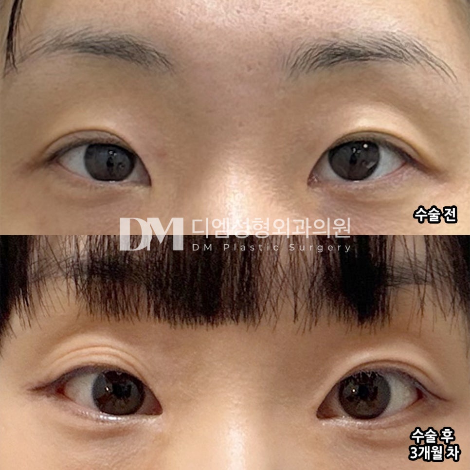 디엠 앞트임/뒤밑트임 수술후기, &ldquo;원했던 대로 눈매 개선된 것 같아 100프로 만족합니다!&rdquo; 관련 이미지 2