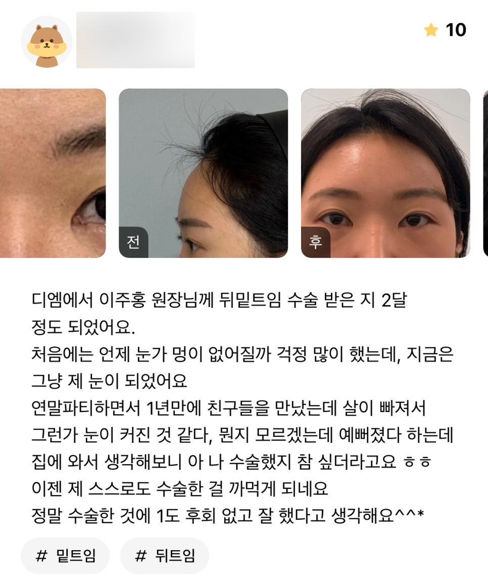 Lateral Canthoplasty Review: “I Have Absolutely No Regrets About the Surgery and Think I Made the Right Choice!” image 1
