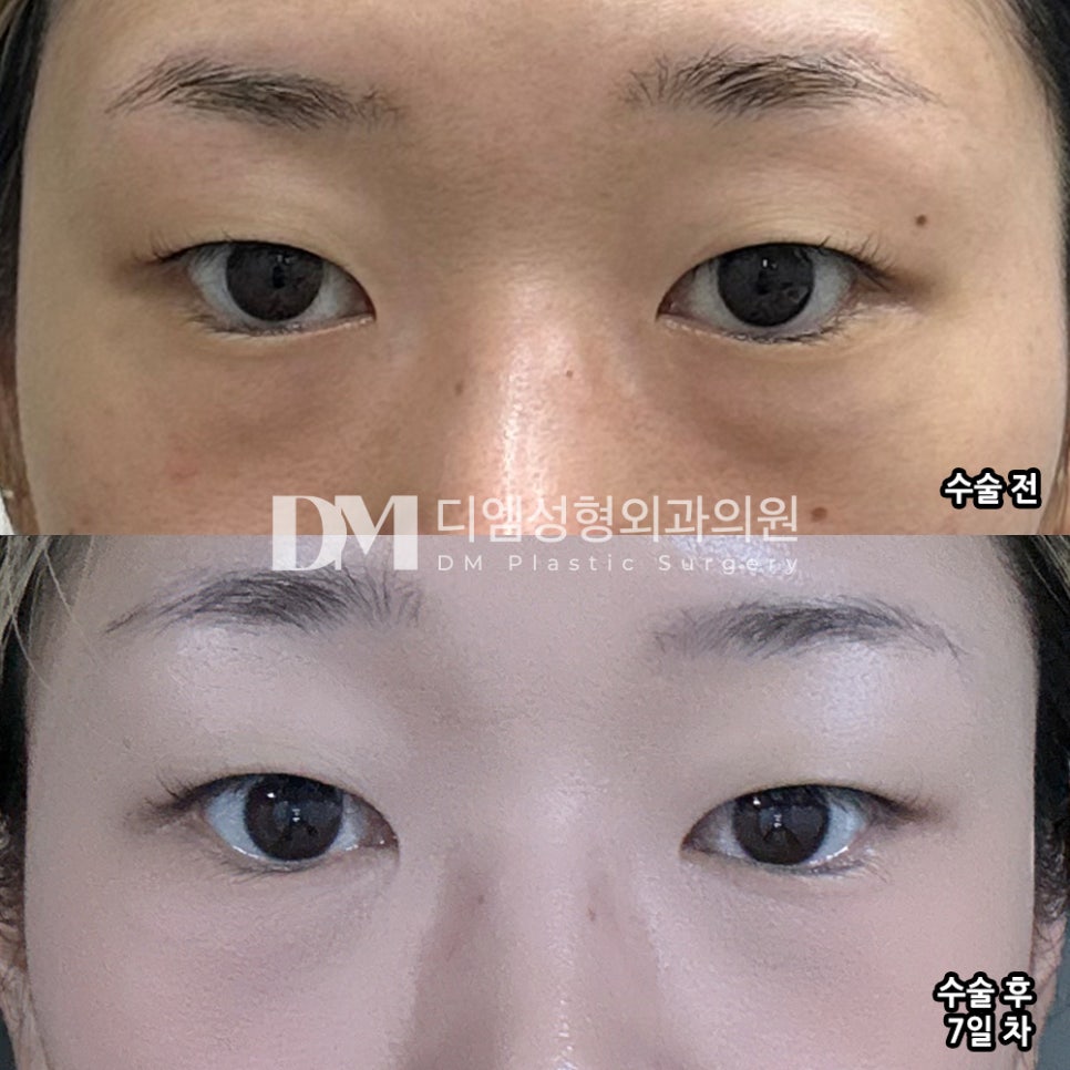 눈밑지방재배치 후기."수술 정말 빠르게 잘 되었습니다. " 관련 이미지 2