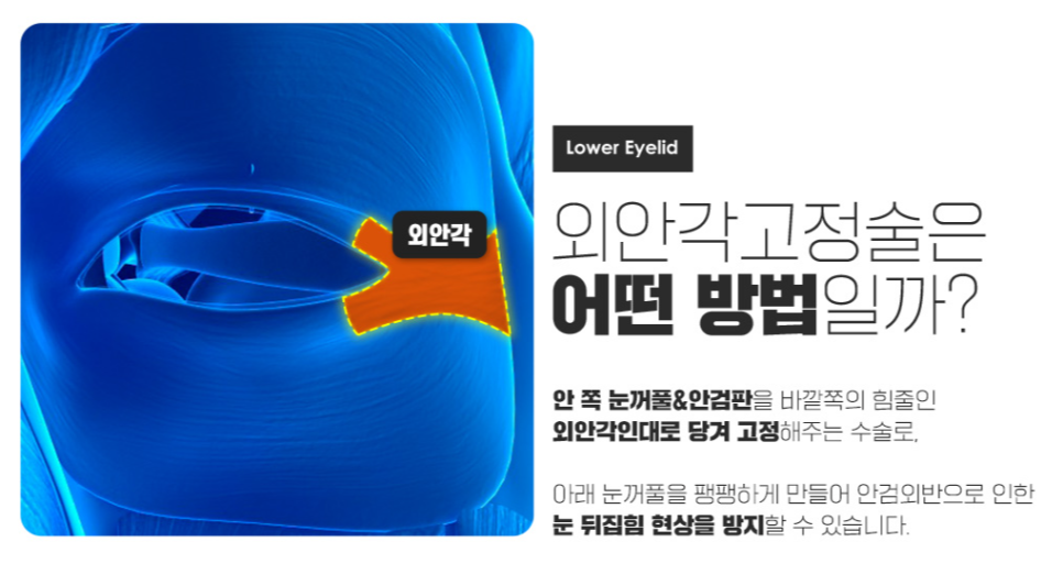 하안검, 밝고 젊어보이는 인상 만들기 관련 이미지 5