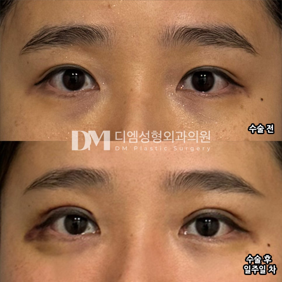 눈재수술 후기."회복도 빠르고 너무 좋아요!" 관련 이미지 2