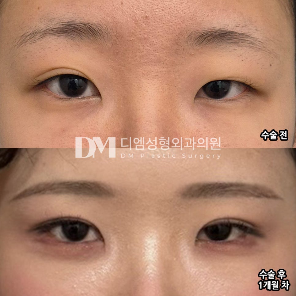 눈재수술 후기."메이크업하면 티 거의 안나서 만족해요!" 관련 이미지 2