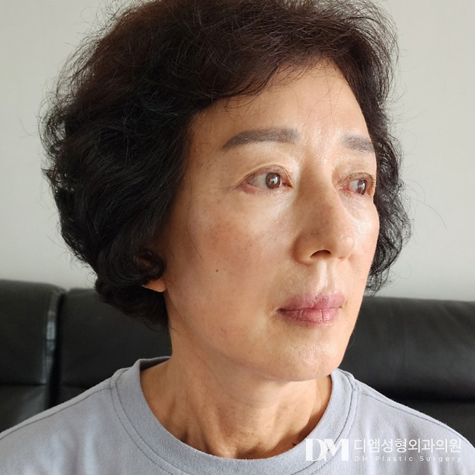 Facelift: Restoring Sagging Skin That Has Lost Its Firmness image 16