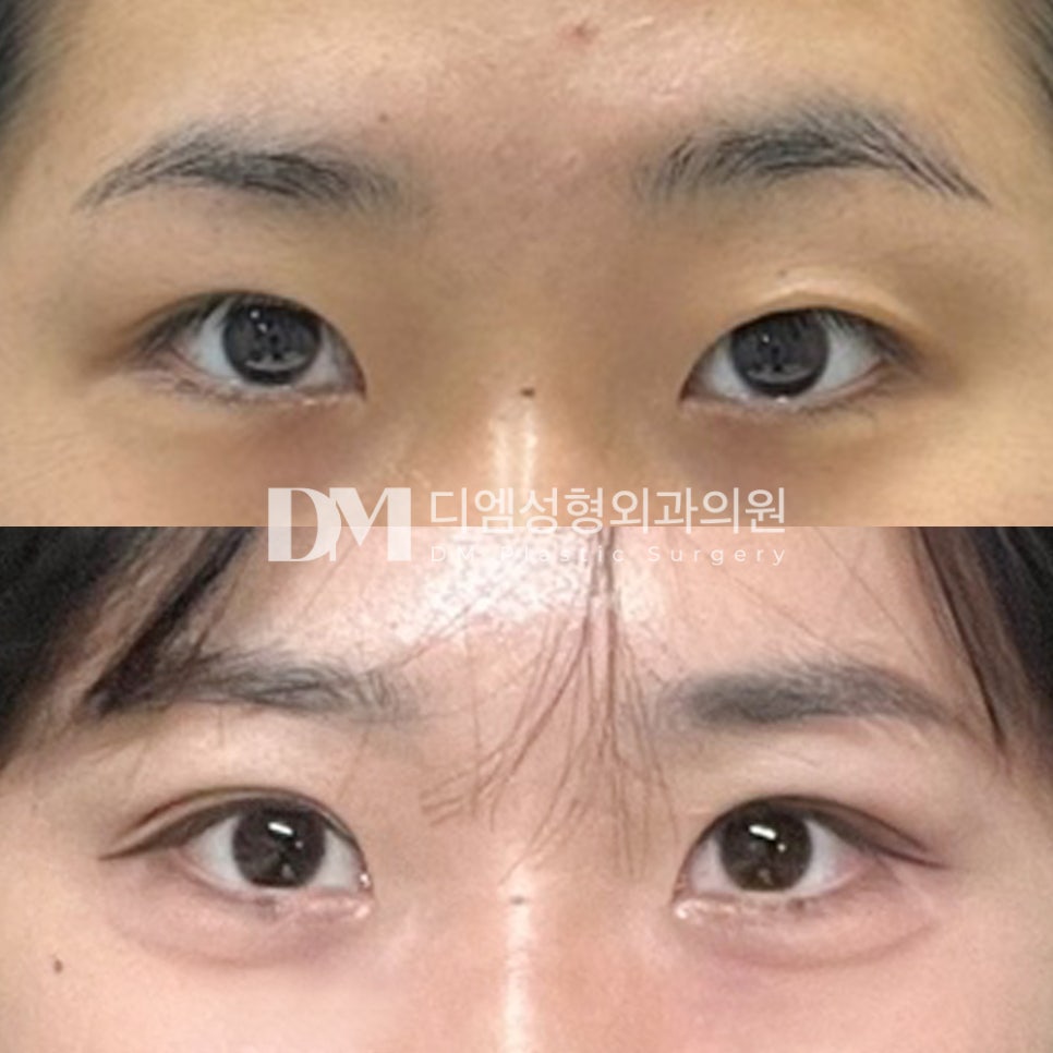 Revision Eye Surgery Review: “You can hardly tell I had surgery, haha!” image 2