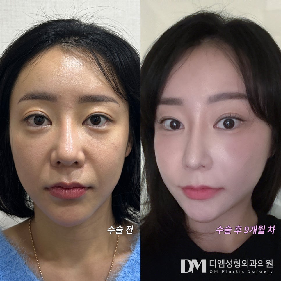 Nasolabial Folds That Make You Look Older: Improve Them Smoothly with a Half Facelift image 7