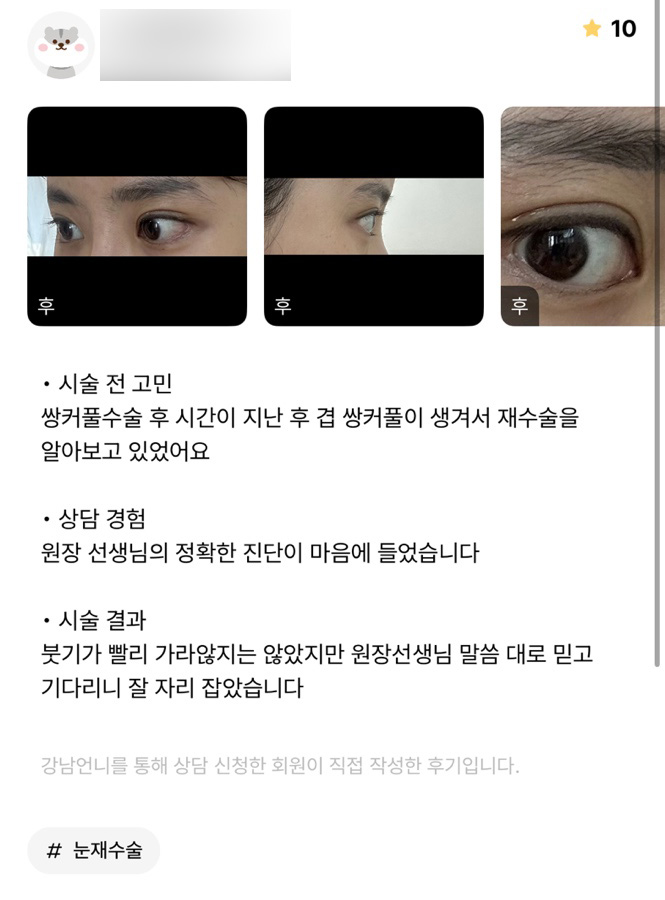 눈재수술 후기."원장님 말씀대로 잘 자리 잡았어요!" 관련 이미지 1