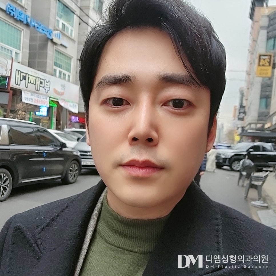 짧고 처진 코 끝, 이목구비에 맞게 개선하려면? 관련 이미지 12