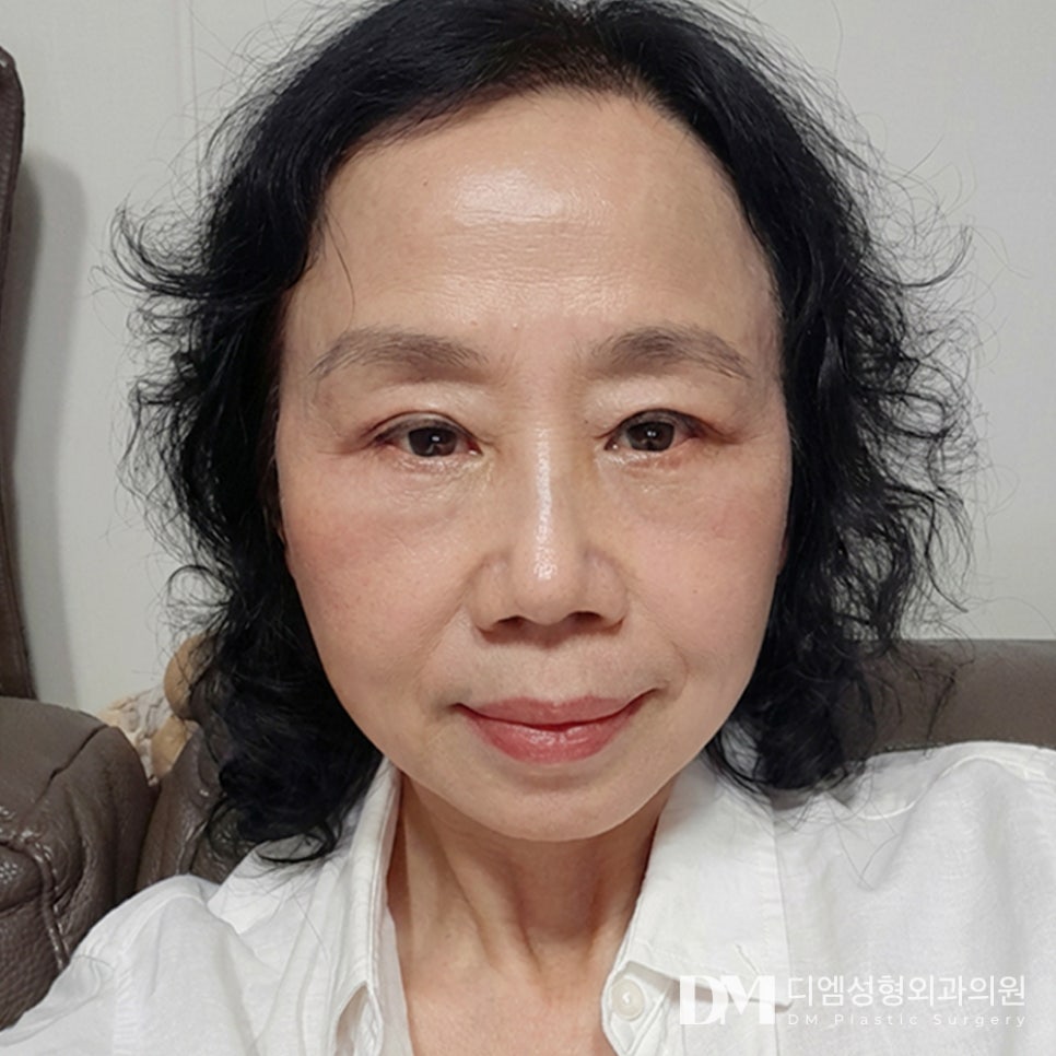 하안검 vs 눈밑지방재배치 차이점! 나에게 맞는 방법은? 관련 이미지 2
