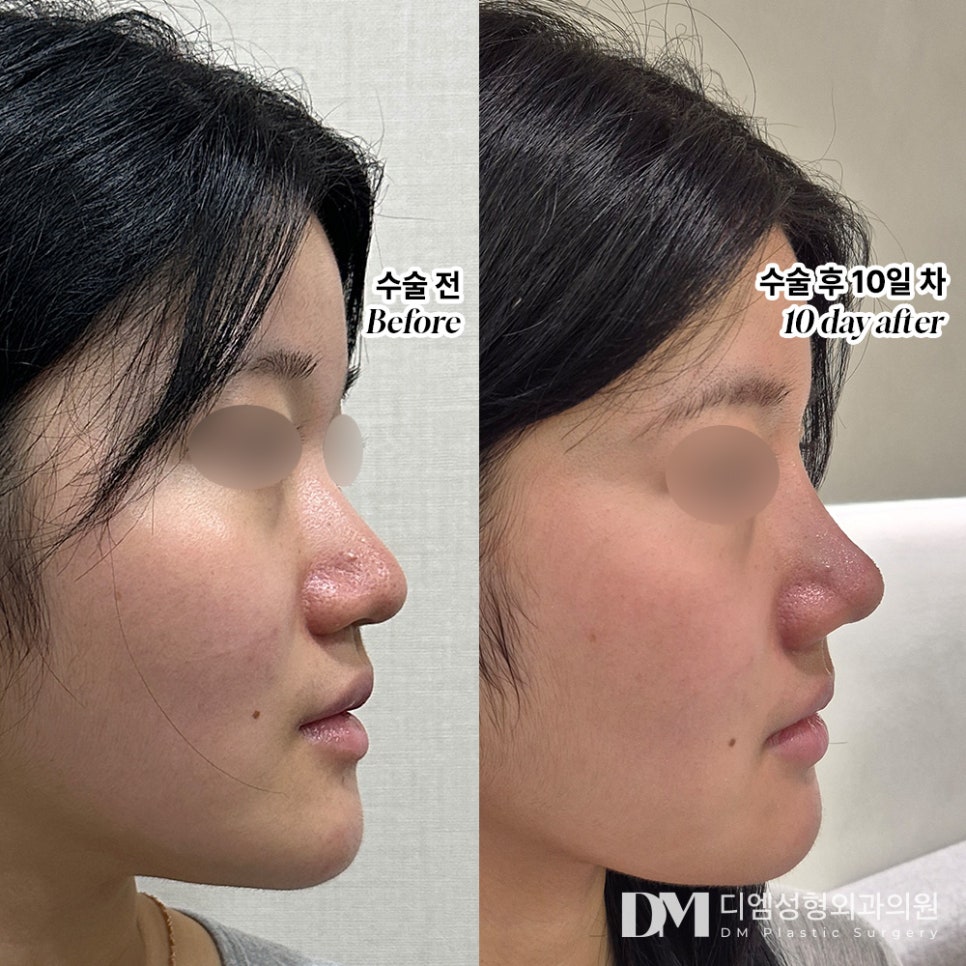 Refining a Round, Drooping Nasal Tip into a Sharper Look! image 8