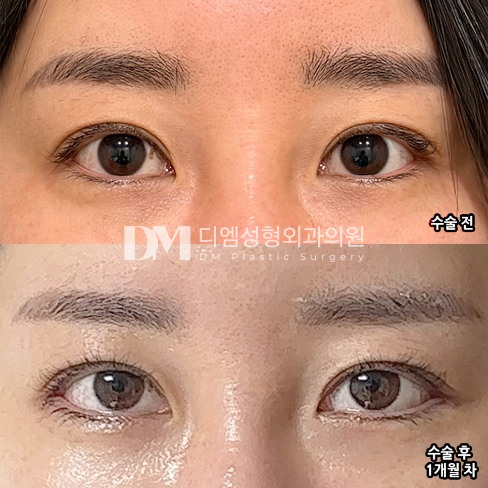 디엠 빵트임 수술후기, “한 달 지났는데 여전히 맘에 들어요!” 관련 이미지 2