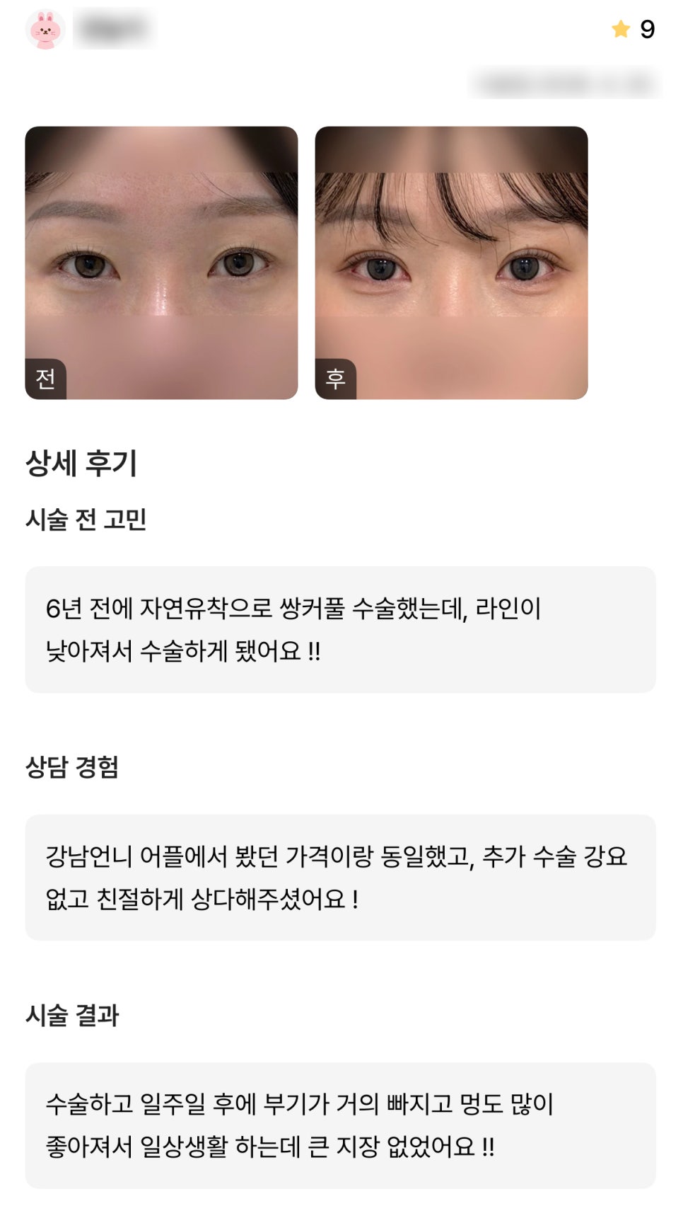 디엠 눈재수술 후기, &ldquo;수술하고 일상생활하는데 큰 지장 없었어요!&rdquo; 관련 이미지 1
