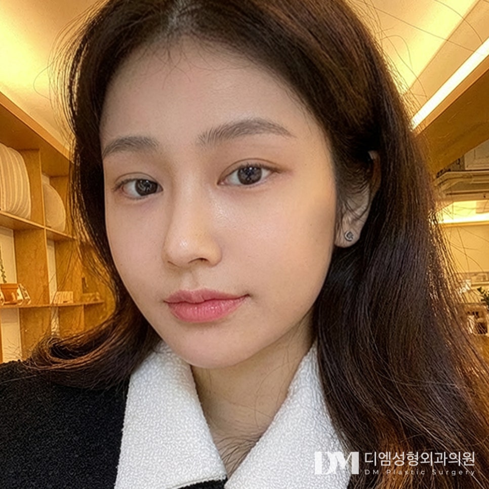 디엠 눈밑지방재배치 후기사진, 단순한 지방 제거와는 다릅니다! 관련 이미지 1