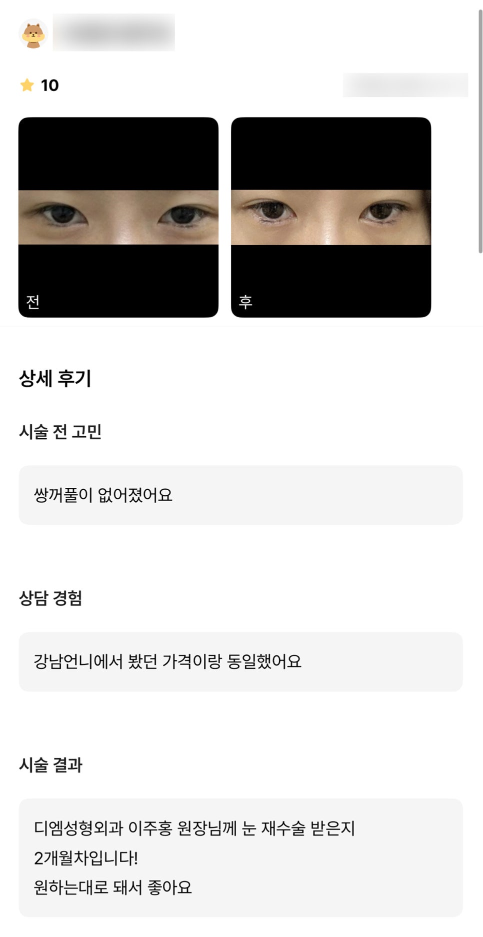 눈재수술 후기."원하는대로 되서 좋아요!" 관련 이미지 1