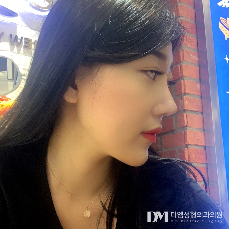 얼굴전체의 비율을 고려해 짧은 코 완벽 교정하기 관련 이미지 11