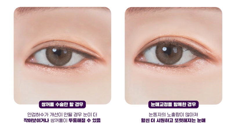 눈매교정, 피곤해보이는 인상 탈출하기 관련 이미지 11