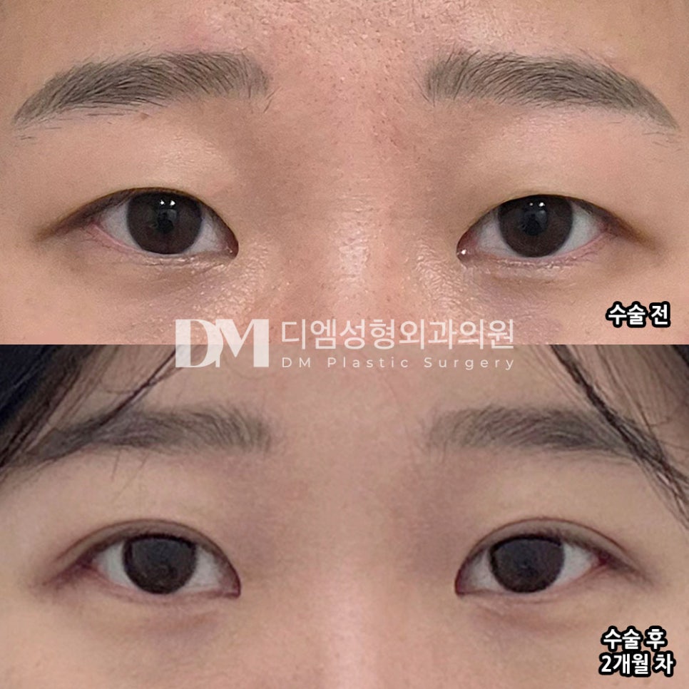 디엠 눈재수술/빵트임 수술후기, &ldquo;가격이 합리적이고 라인이 마음에 들어요!&rdquo; 관련 이미지 2