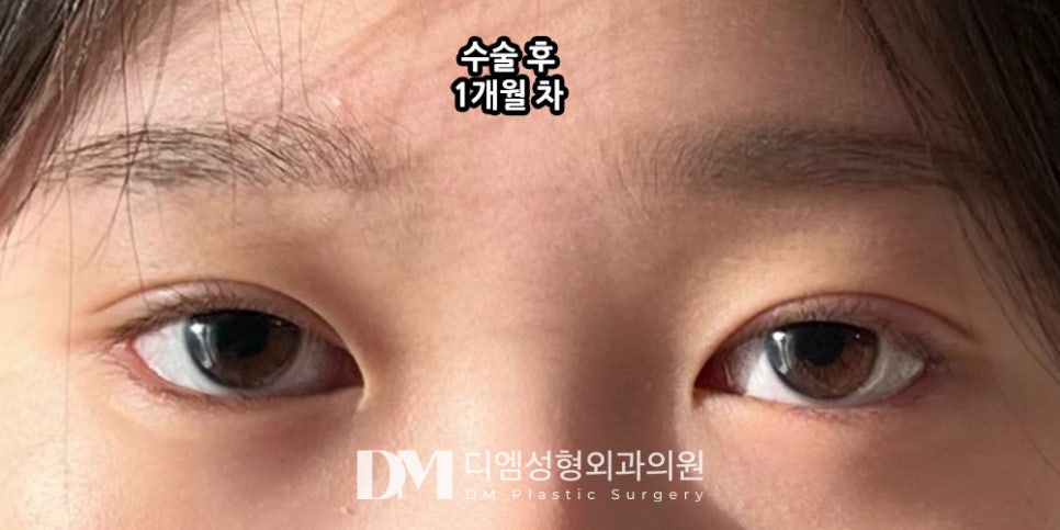 눈매교정, 이미지와 기능까지 동시개선 ! 관련 이미지 13