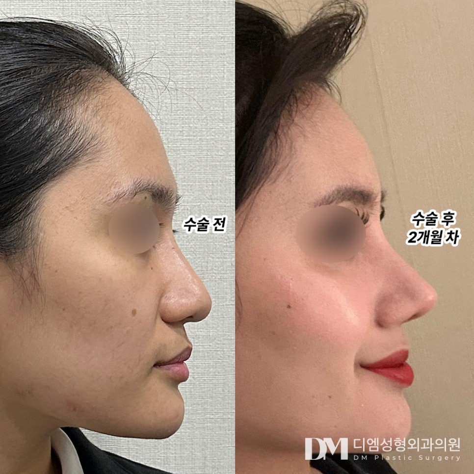 긴 코 성형 , 이목구비 비율을 조화롭게 관련 이미지 6
