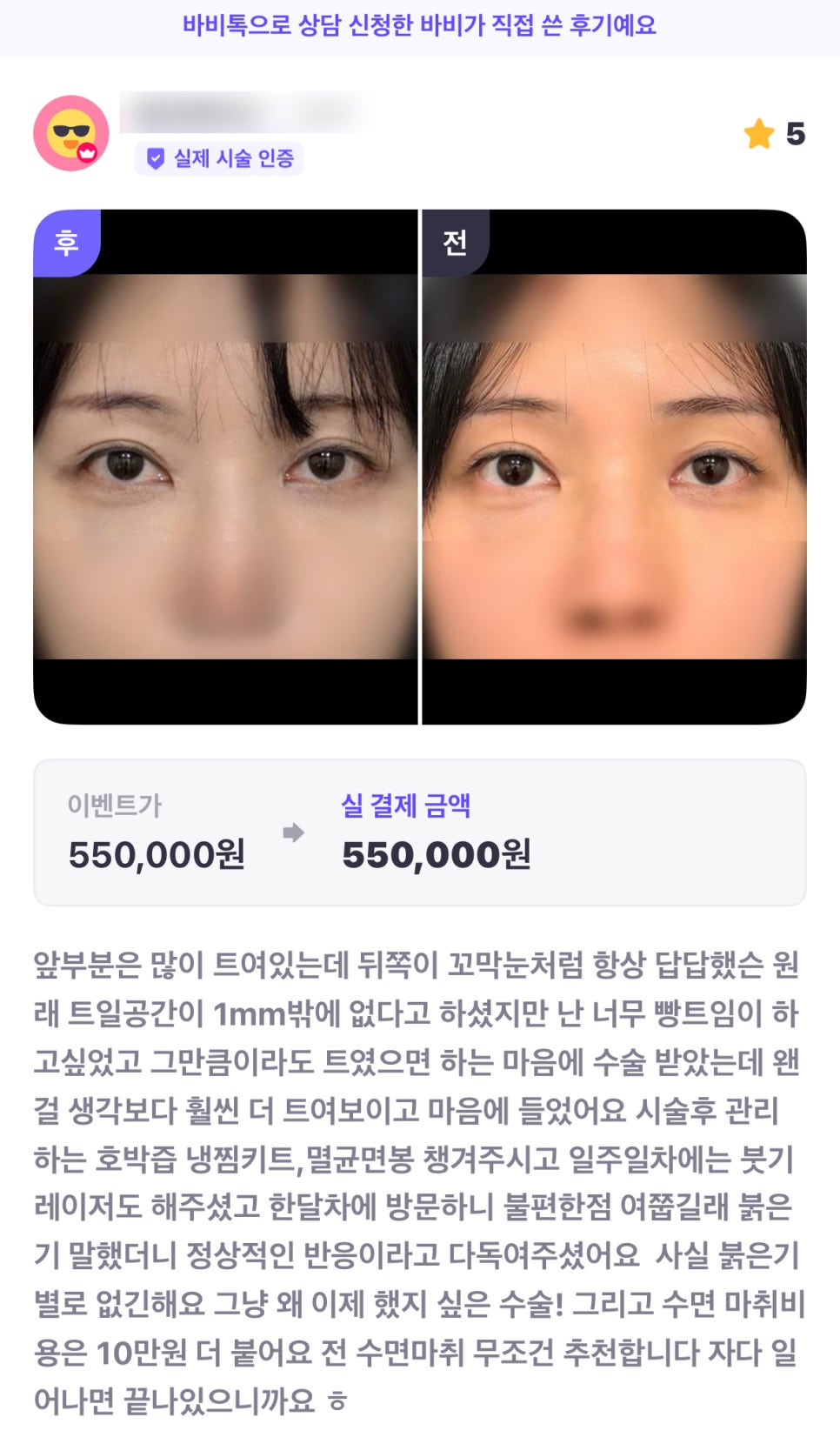 디엠 빵트임 수술후기, &ldquo;왜 이제야 했지 싶은 수술이에요!&rdquo; 관련 이미지 1
