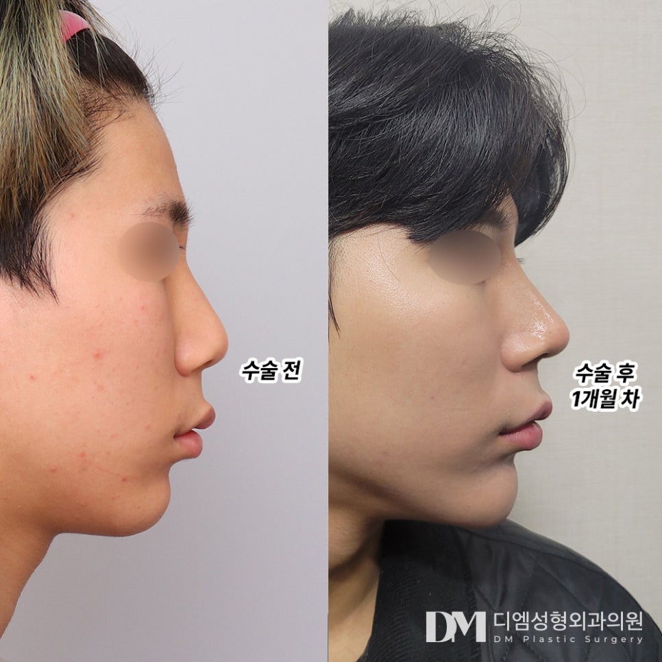 Tip Rhinoplasty: Want to Create a Refined Nose Line? image 8