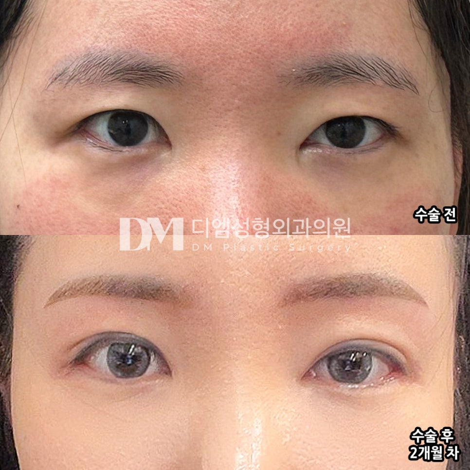 Blepharoplasty review. "It looks natural without being noticeable, and I look much more lively!" image 2