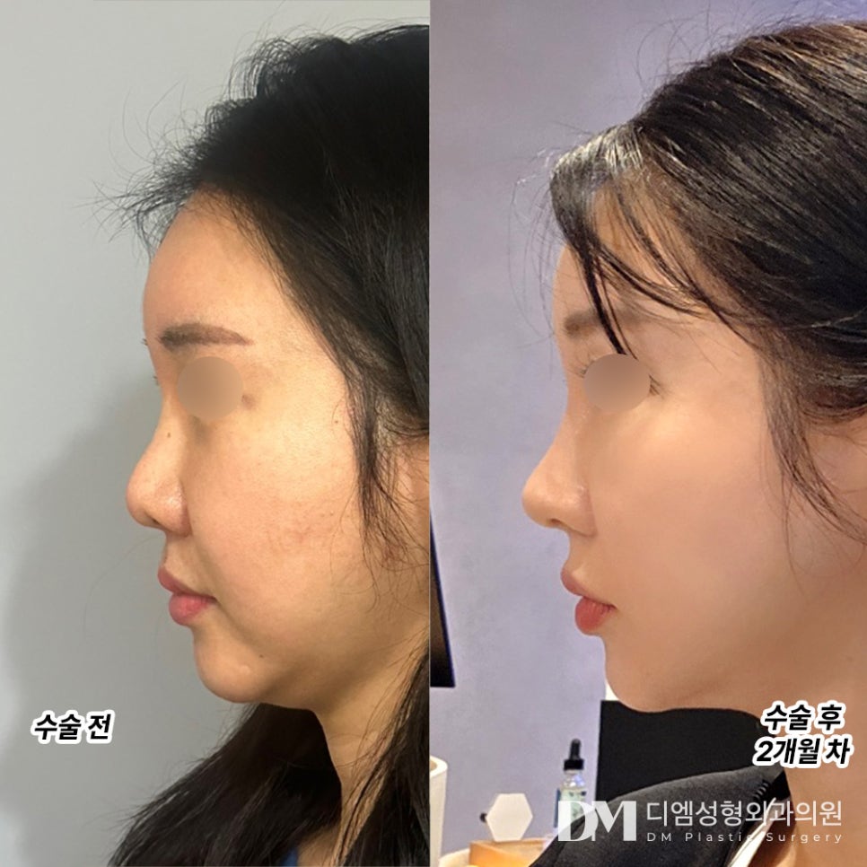 코성형 후기."염증, 붓기 전혀 없었어요!" 관련 이미지 2