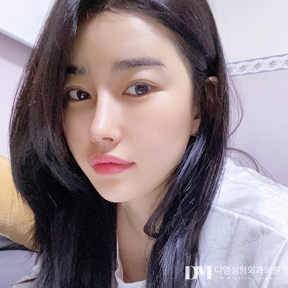 매부리코 성형, 매끈한 콧등라인을 원한다면?! 관련 이미지 1