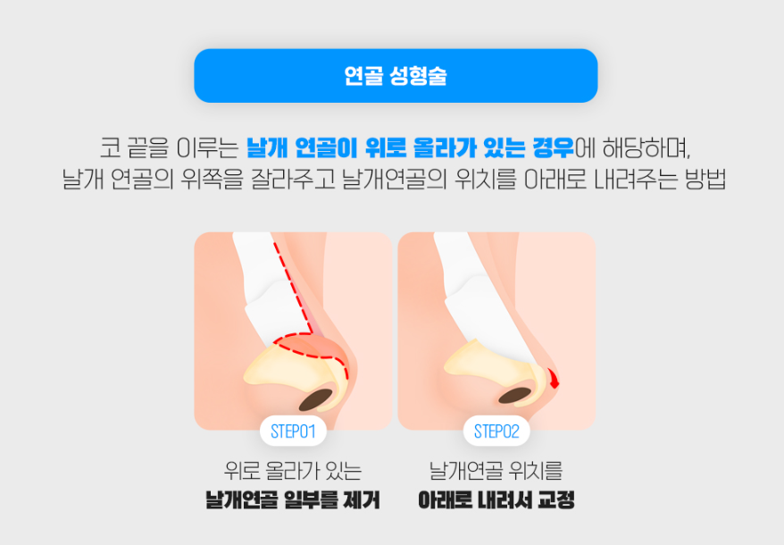 짧은코성형, 무조건 늘리고 높이기 보다 자연스럽게 맞춤형으로! 관련 이미지 5