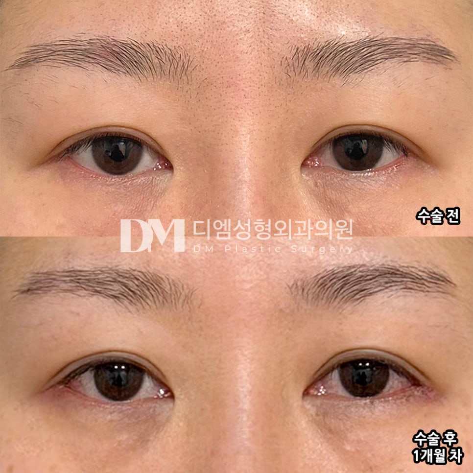 디엠 빵트임 수술후기, &ldquo;고민이었던 부분이 확 개선되었습니다!&rdquo; 관련 이미지 2