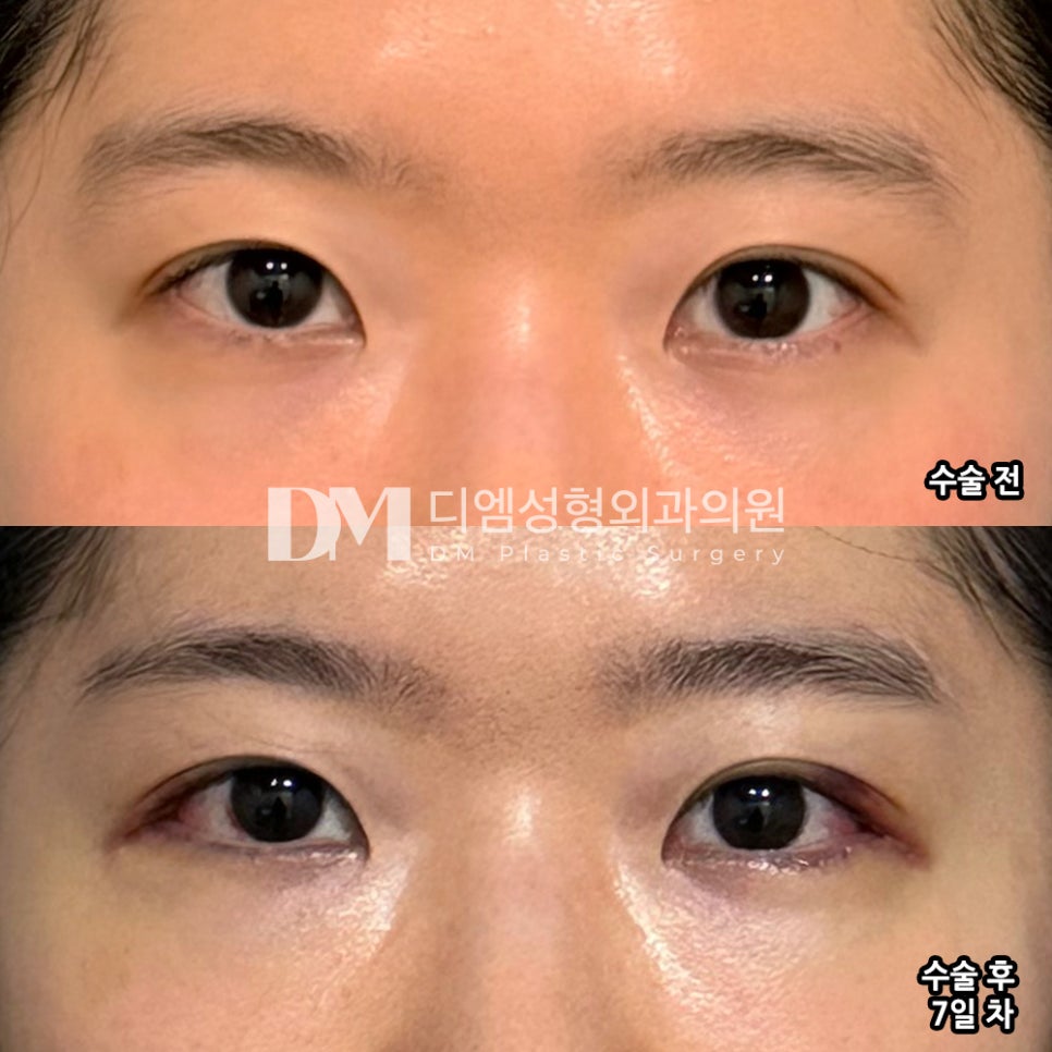 뒤밑트임 후기."원장님도 친절하시고 수술도 잘 된 것 같아 추천드립니다." 관련 이미지 2
