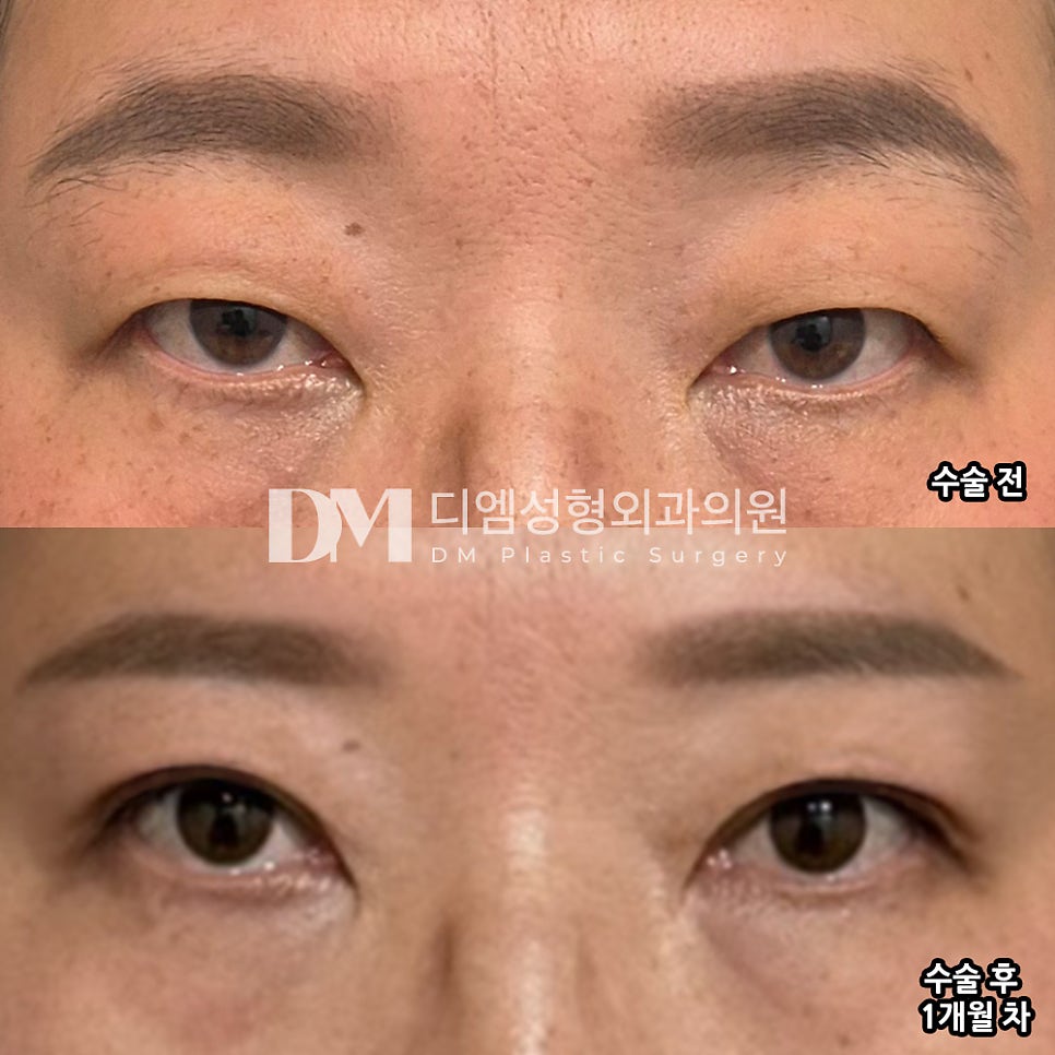 Upper Blepharoplasty Review. "I've heard many people say it turned out so well, and I'm satisfied!" image 2