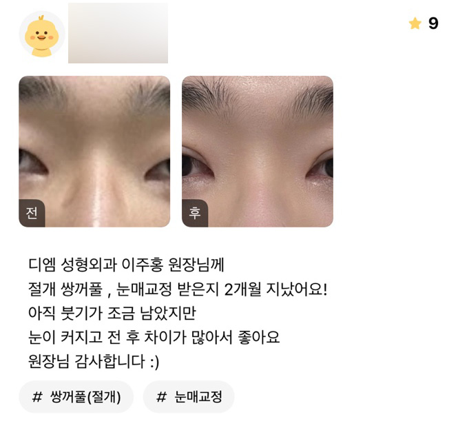 Eye Surgery Review: “I’m happy because my eyes look bigger and the before-and-after difference is significant!” image 1