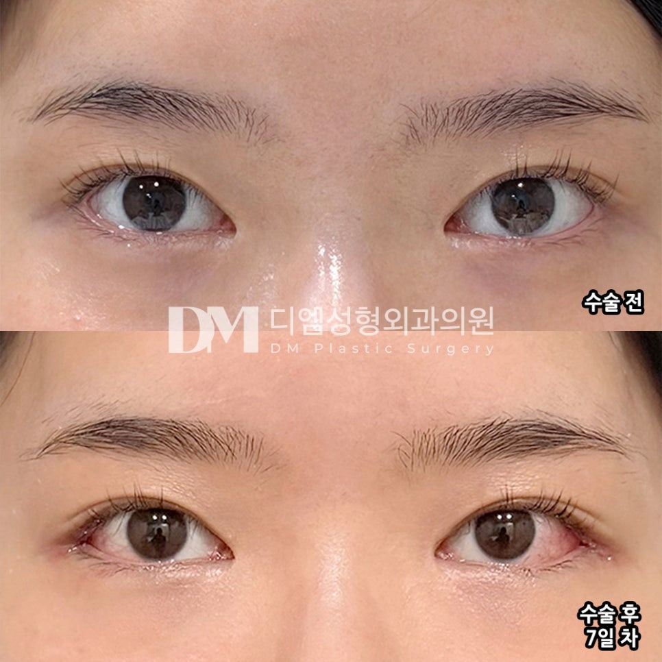 디엠 뒤밑트임/트임성형 후기, “눈매가 훨씬 시원해지고 또렷해졌어요!” 관련 이미지 2