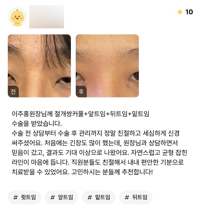 눈성형 후기."자연스럽고 균형잡힌 라인이 마음에 들어요!" 관련 이미지 1