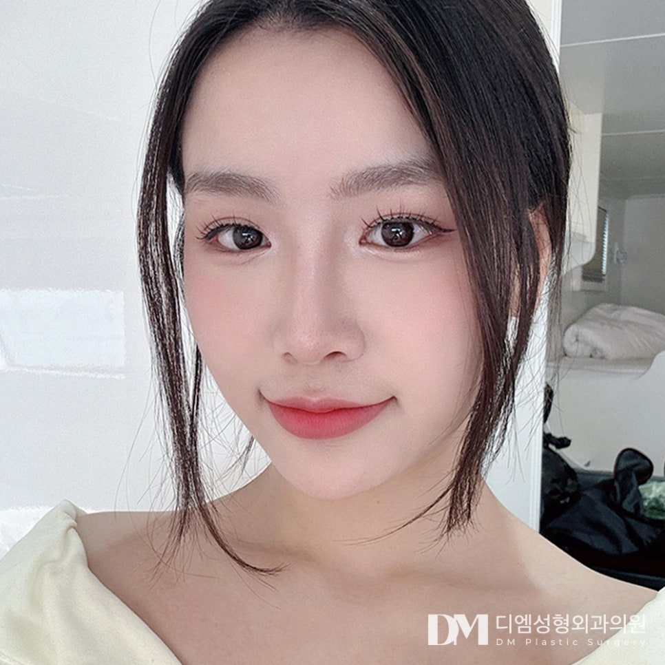 디엠 뒤밑트임 전후사진, 자연스럽게 트인 눈매 가능할까? 관련 이미지 1