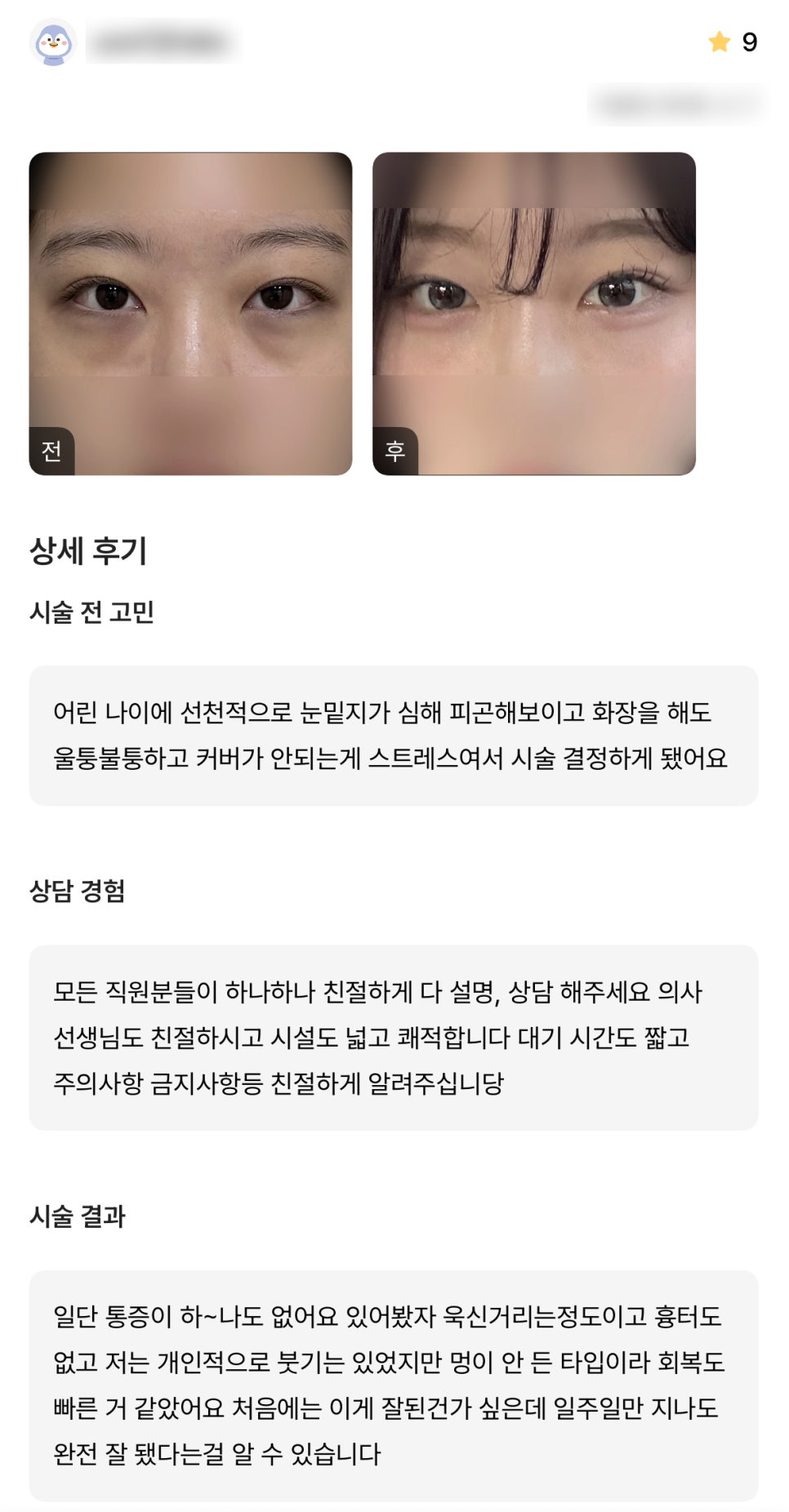 디엠 눈밑지방재배치 수술후기, “수술 일주일만 지나도 완전 잘됐다는 걸 알 수 있어요!” 관련 이미지 1