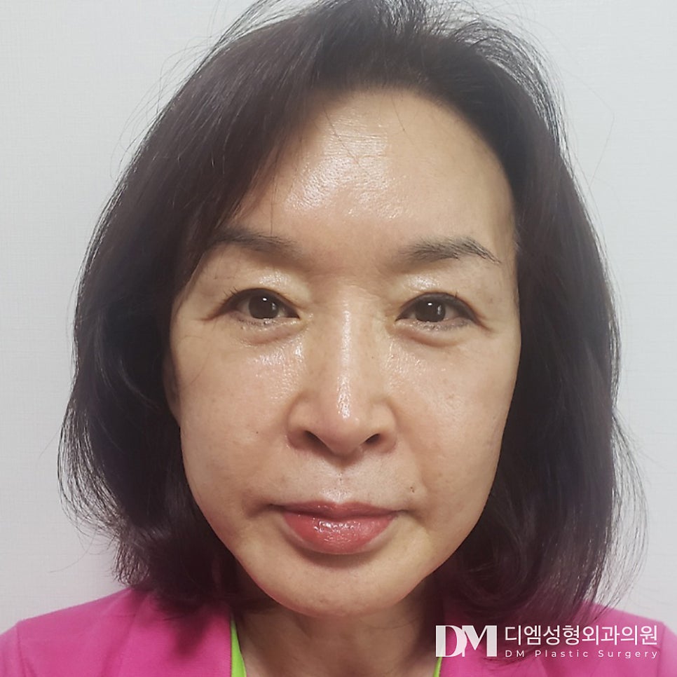 Improving Droopy Eyes with Upper Blepharoplasty image 13