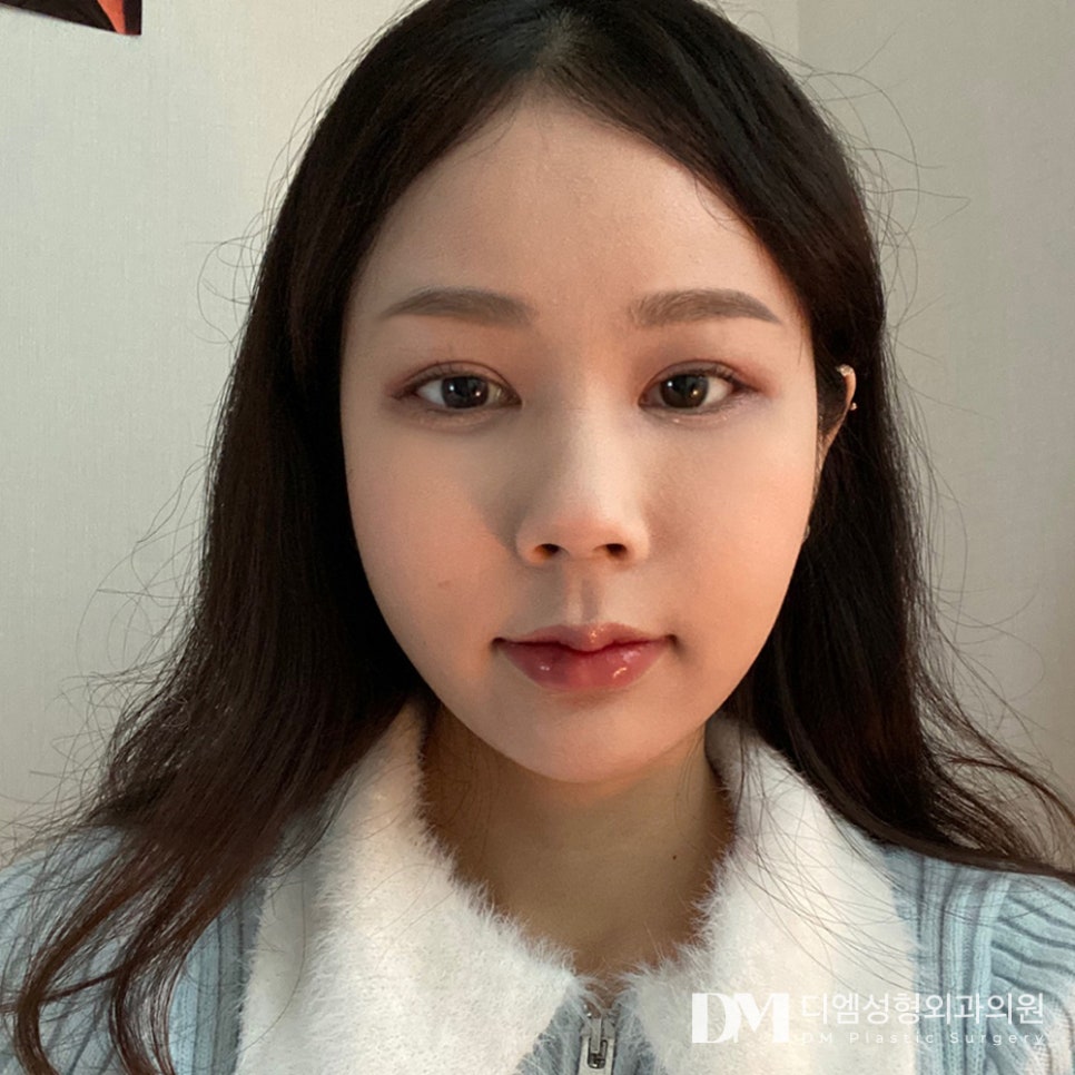 Ptosis Correction: Turning Tired-Looking Eyes into Clear, Bright Eyes image 1