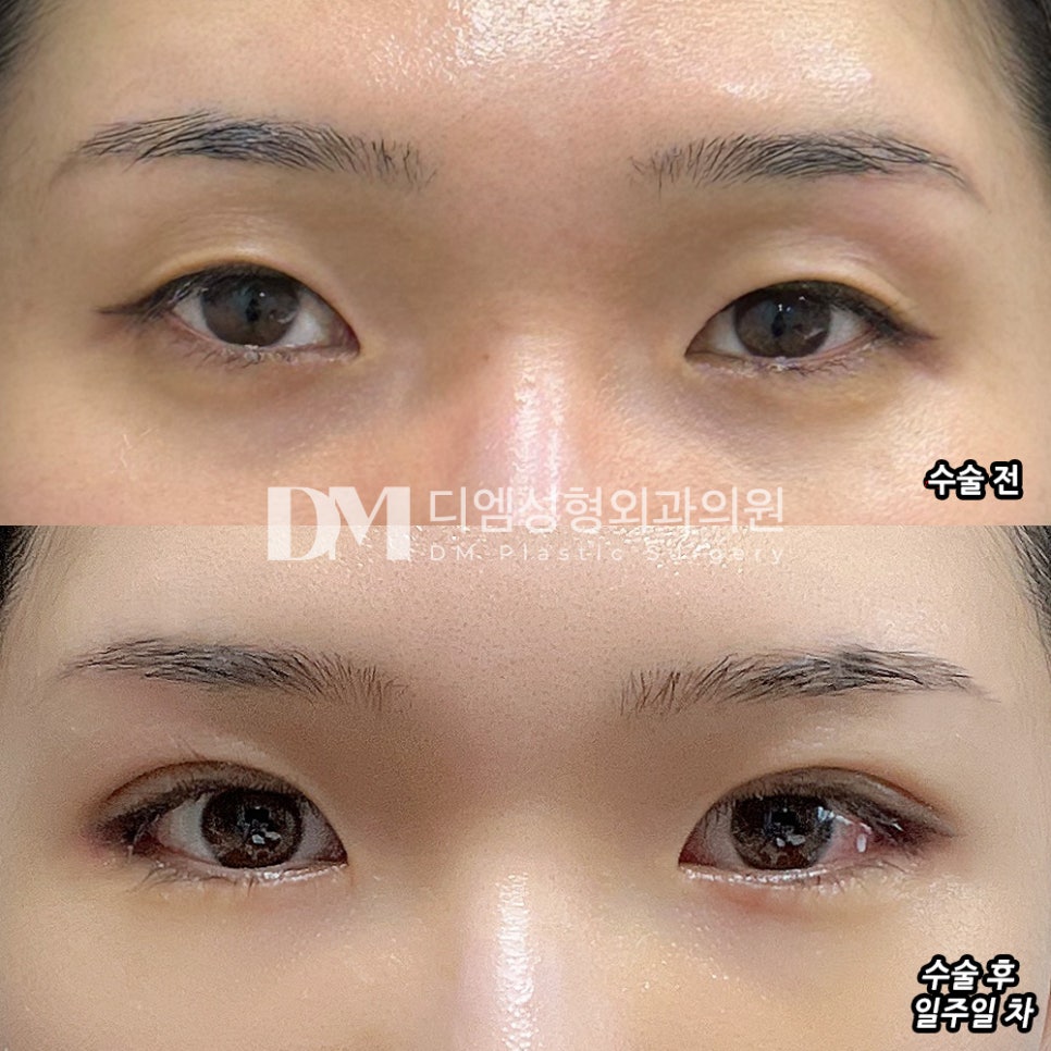 Double Eyelid Surgery: Which Line Suits My Eyes? image 10