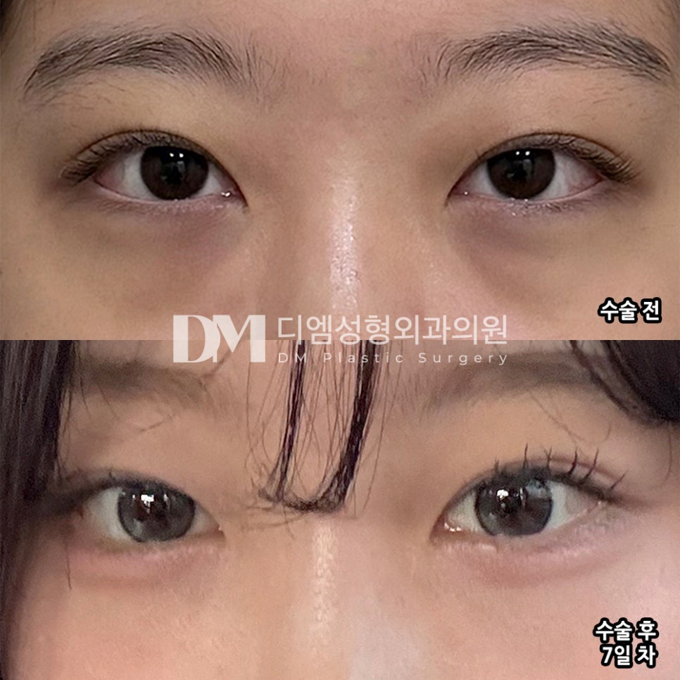 디엠 눈밑지방재배치 수술후기, “수술 일주일만 지나도 완전 잘됐다는 걸 알 수 있어요!” 관련 이미지 2
