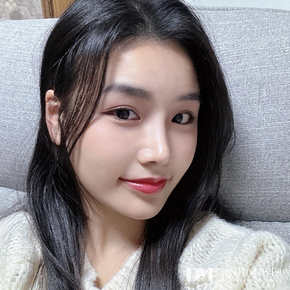 디엠 뒤밑트임 전후사진, 선하고 시원해진 눈매의 비결은? 관련 이미지 1