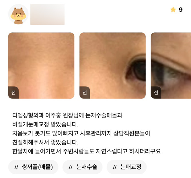 눈재수술 후기."주변사람들도 자연스럽대요 ~!" 관련 이미지 1