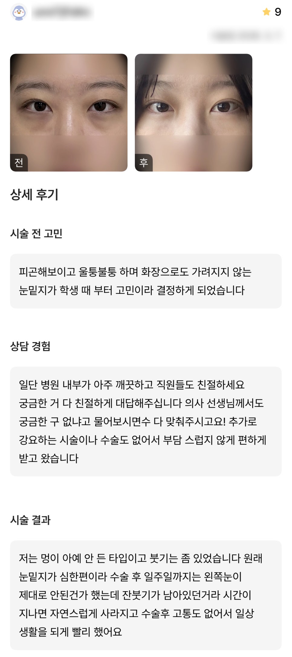 DM Under-Eye Fat Repositioning Surgery Review, &ldquo;I had no pain after the surgery, so I was able to get back to daily life really quickly!&rdquo; image 1