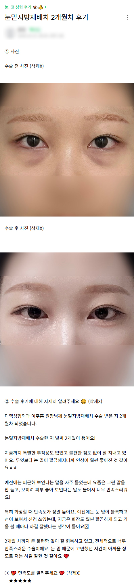 디엠 눈밑지방재배치 수술후기, “전체적으로 너무 만족스러운 수술이에요!” 관련 이미지 1