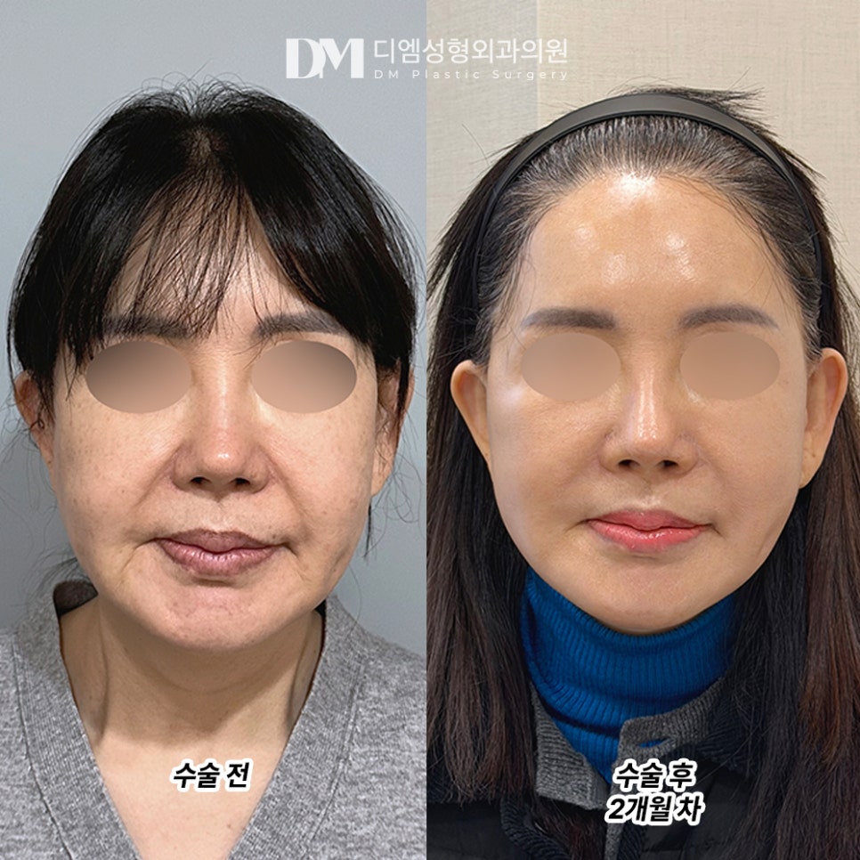 디엠 안면거상 전후사진, 거울 보기 속상했던 날들은 안녕! 관련 이미지 2