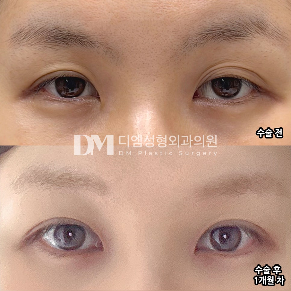 DM Eye Shape Correction/Eye Surgery Review, “I’m satisfied because it turned out exactly as I wanted without being excessive!” image 2
