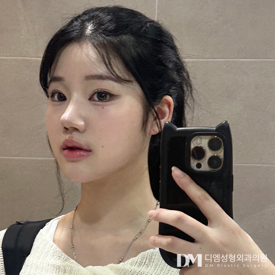 Hump Nose Surgery: Improving Both Appearance and Internal Function! image 1