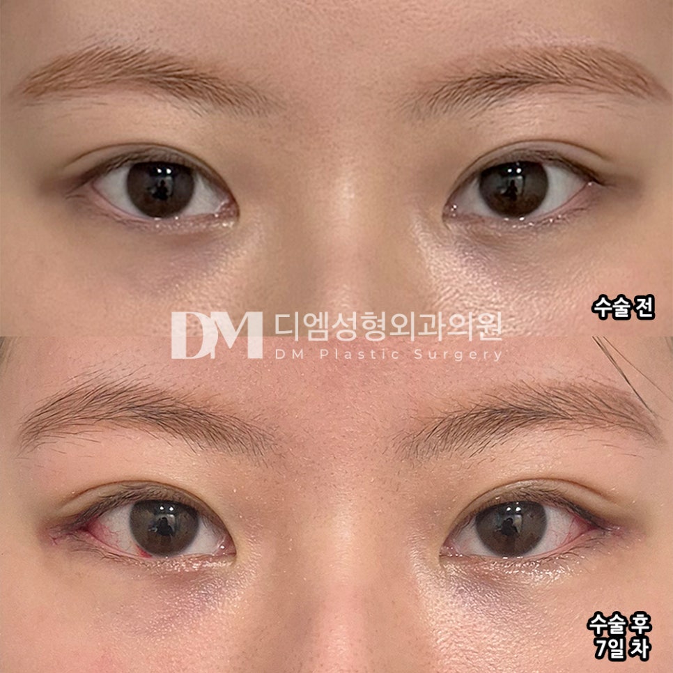 DM Canthoplasty Surgery Review, “I’m Extremely Satisfied Every Time I Look in the Mirror!” image 2