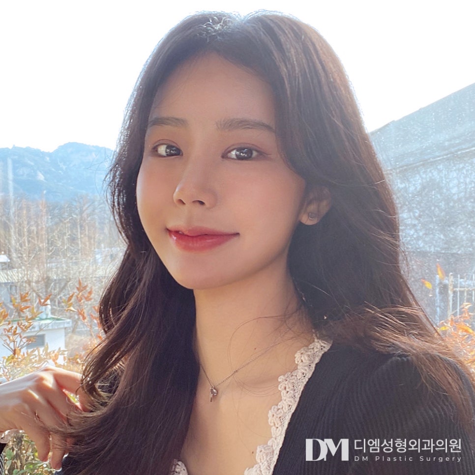 디엠 눈재수술 전후사진, 불만족스러운 쌍꺼풀 고민 끝! 관련 이미지 1