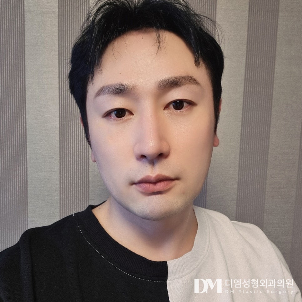 DM Men's Eye Correction Before-and-After Photos, Escape Sleepy Eyes! How to Make Them Look Simple and Clear? image 3